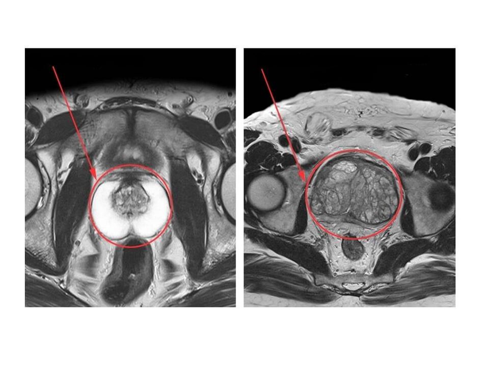 Comparison of a healthy (left) and an inflamed (right) prostate on MRI images
